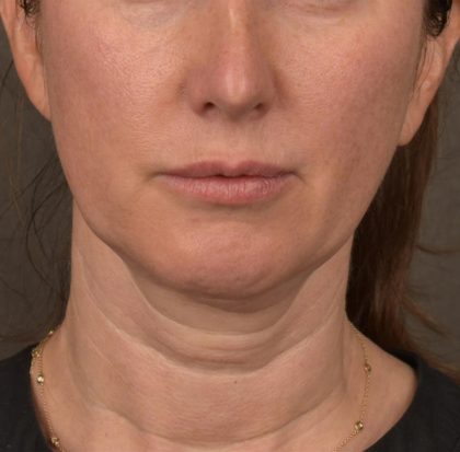 Neck Lift Before & After Patient #3663