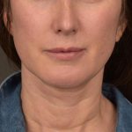 Neck Lift Before & After Patient #3663