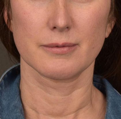 Neck Lift Before & After Patient #3663