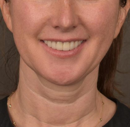 Neck Lift Before & After Patient #3663