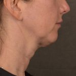 Neck Lift Before & After Patient #3663