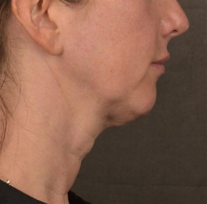 Neck Lift Before & After Patient #3663