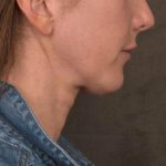 Neck Lift Before & After Patient #3663