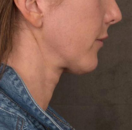Neck Lift Before & After Patient #3663