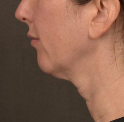 Neck Lift Before & After Patient #3663