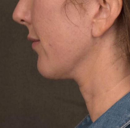 Neck Lift Before & After Patient #3663