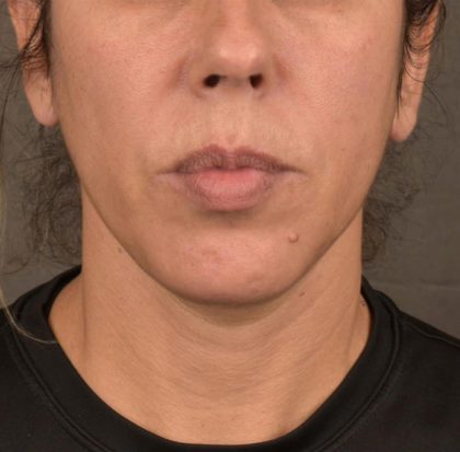 Neck Lift Before & After Patient #3659