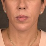 Neck Lift Before & After Patient #3659