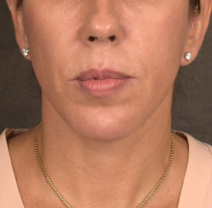 Neck Lift Before & After Patient #3659