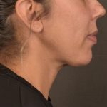 Neck Lift Before & After Patient #3659