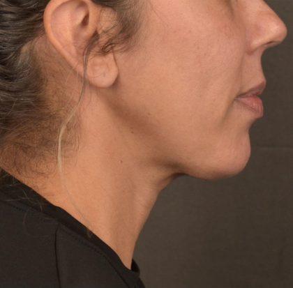 Neck Lift Before & After Patient #3659
