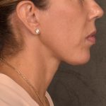Neck Lift Before & After Patient #3659