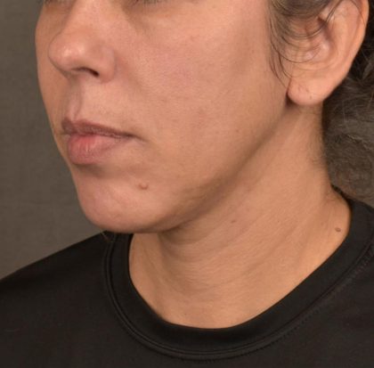 Neck Lift Before & After Patient #3659