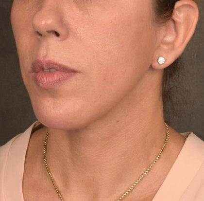 Neck Lift Before & After Patient #3659