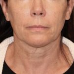 Neck Lift Before & After Patient #3668