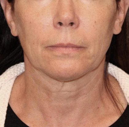 Neck Lift Before & After Patient #3668