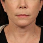 Neck Lift Before & After Patient #3668