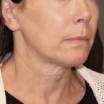Neck Lift Before & After Patient #3668