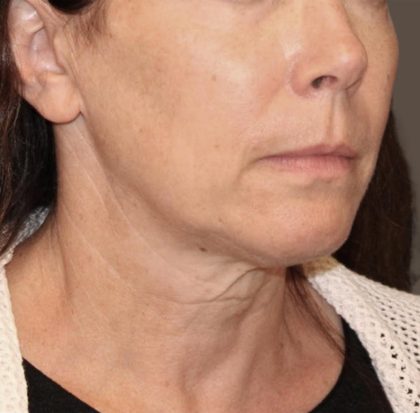 Neck Lift Before & After Patient #3668