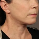 Neck Lift Before & After Patient #3668