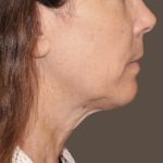 Neck Lift Before & After Patient #3668