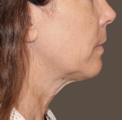 Neck Lift Before & After Patient #3668