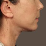 Neck Lift Before & After Patient #3668