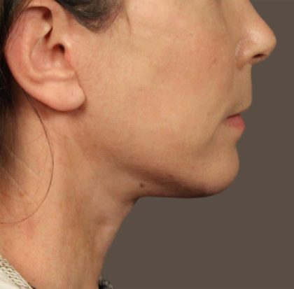Neck Lift Before & After Patient #3668
