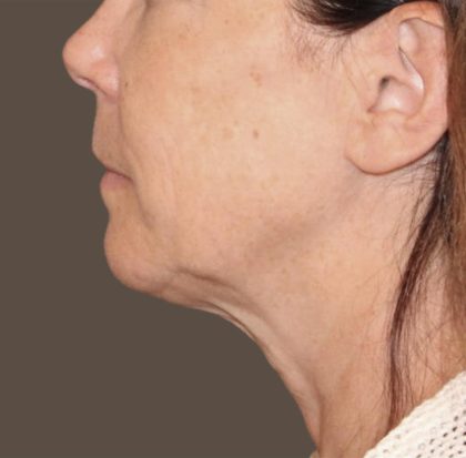 Neck Lift Before & After Patient #3668