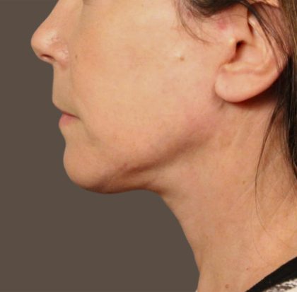 Neck Lift Before & After Patient #3668