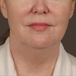 Neck Lift Before & After Patient #3669