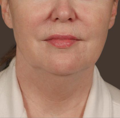 Neck Lift Before & After Patient #3669