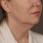 Neck Lift Before & After Patient #3669