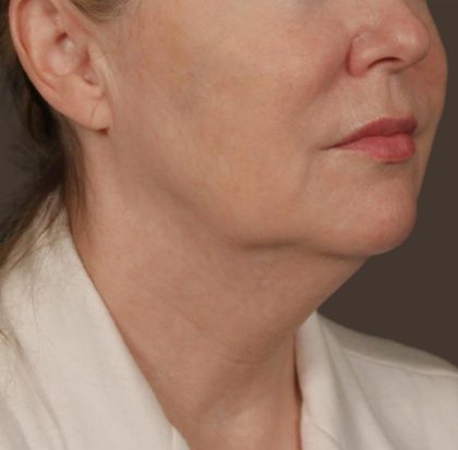 Neck Lift Before & After Patient #3669