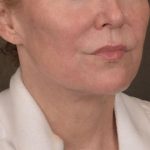 Neck Lift Before & After Patient #3669