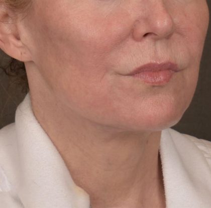 Neck Lift Before & After Patient #3669
