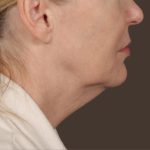 Neck Lift Before & After Patient #3669