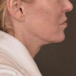 Neck Lift Before & After Patient #3669