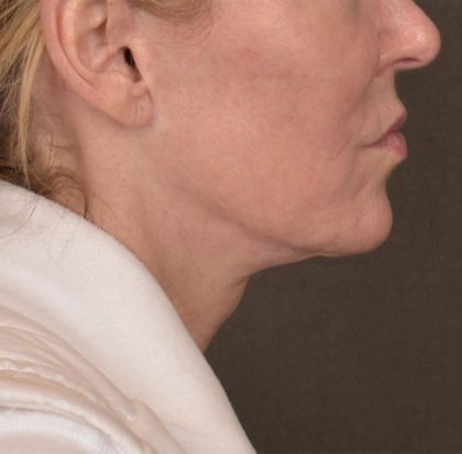 Neck Lift Before & After Patient #3669