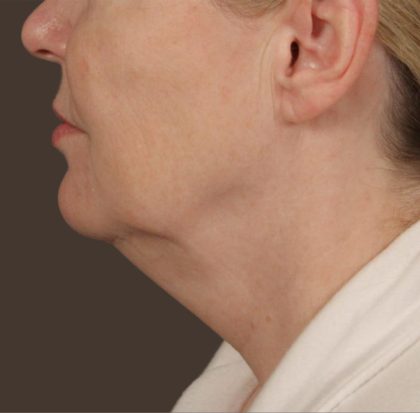 Neck Lift Before & After Patient #3669