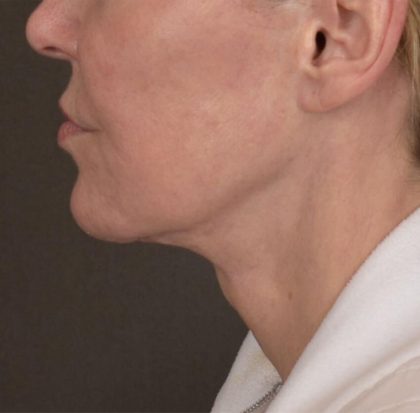 Neck Lift Before & After Patient #3669