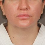 Neck Lift Before & After Patient #3670