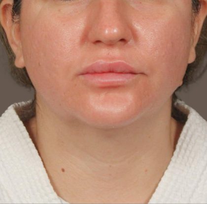 Neck Lift Before & After Patient #3670