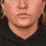Neck Lift Before & After Patient #3670