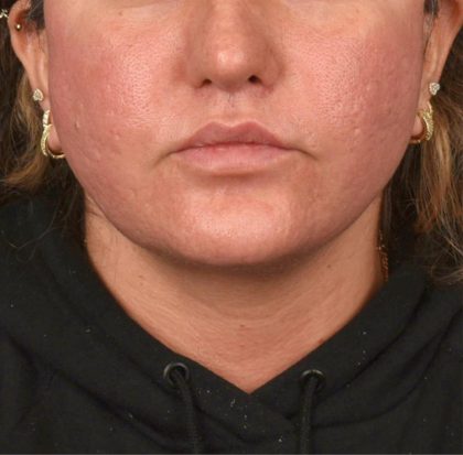 Neck Lift Before & After Patient #3670
