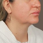 Neck Lift Before & After Patient #3670