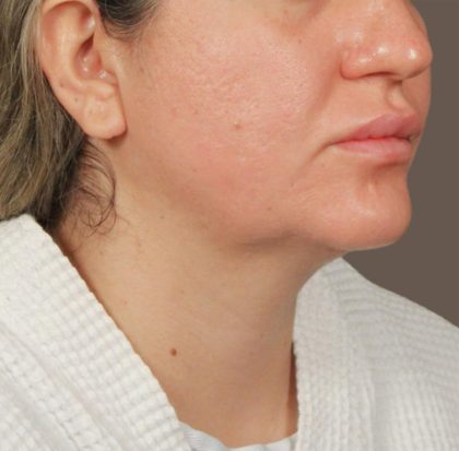 Neck Lift Before & After Patient #3670