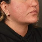Neck Lift Before & After Patient #3670