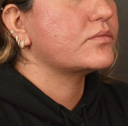 Neck Lift Before & After Patient #3670