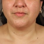 Neck Lift Before & After Patient #3671